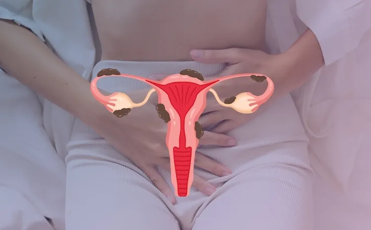 Deep Infiltrating Endometriosis (DIE)