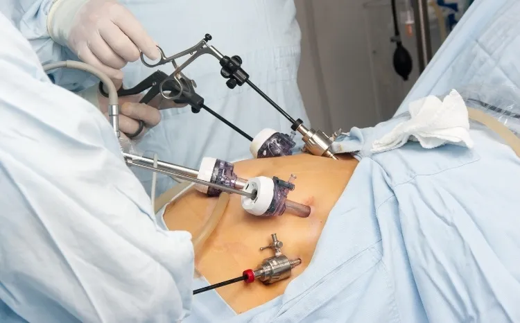 Roux-en-Y Gastric Bypass Surgery