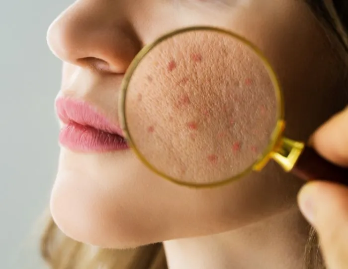 Acne Vulgaris