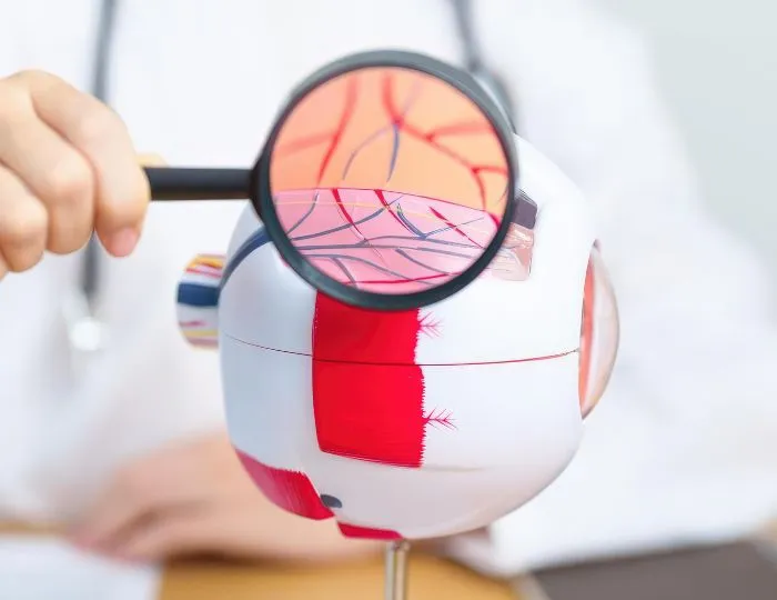 Brain Aneurysm