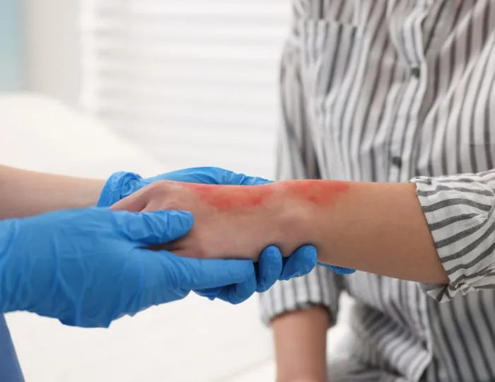 Burns & Burn Contractures
