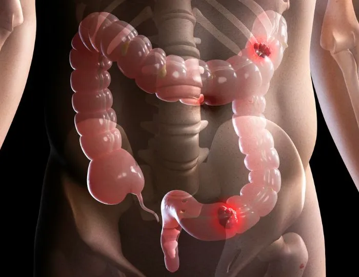 Colorectal Cancer