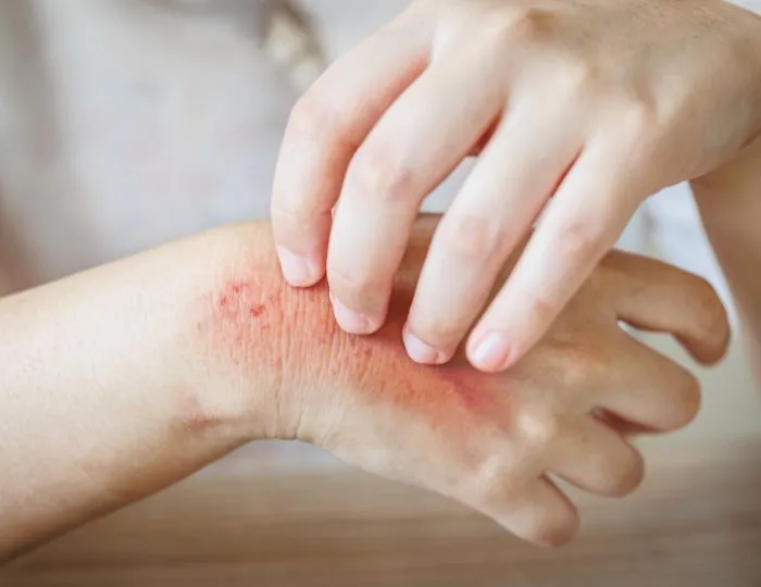 Fungal Skin Infections