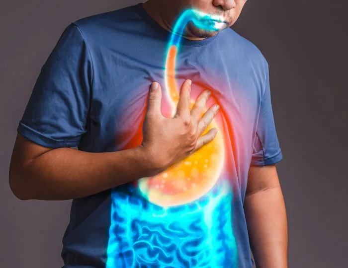 GERD (Acid Reflux)