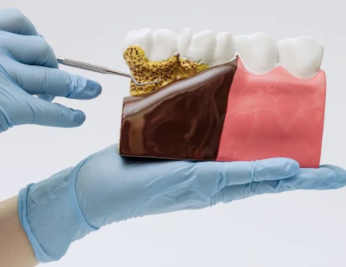 Gum Disease (Gingivitis _ Periodontitis)