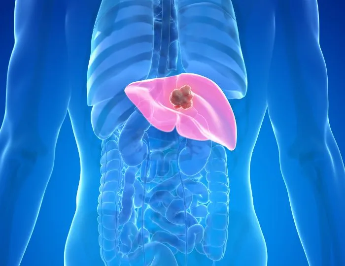Liver Tumours