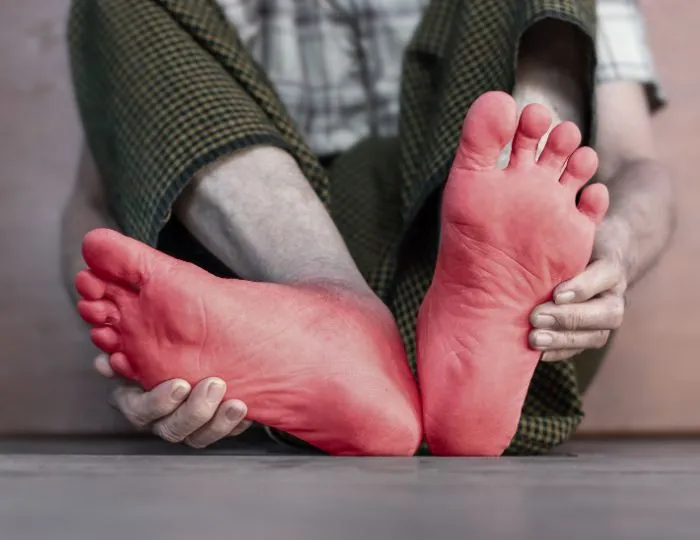 Peripheral Neuropathy