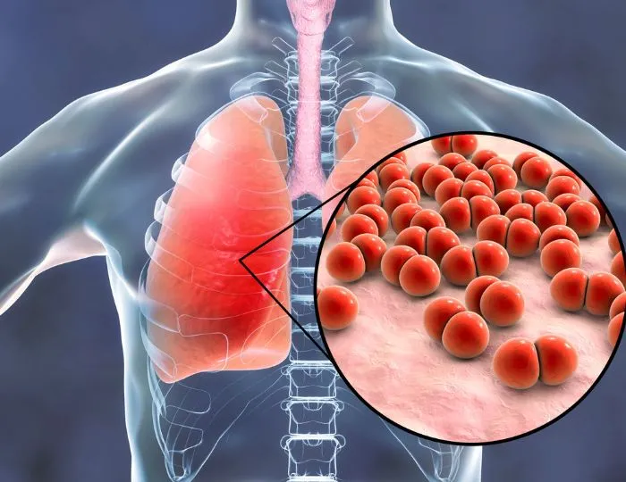 Pneumonia