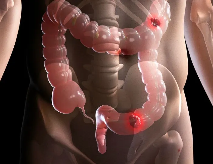 Rectal Cancer