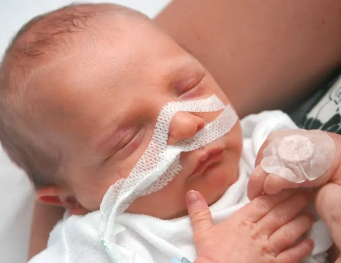 Respiratory Distress Syndrome (RDS)