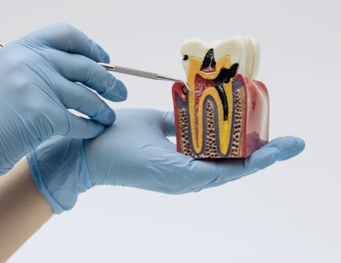 Tooth Decay (Dental Caries)