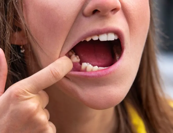 Tooth Loss (Edentulism)